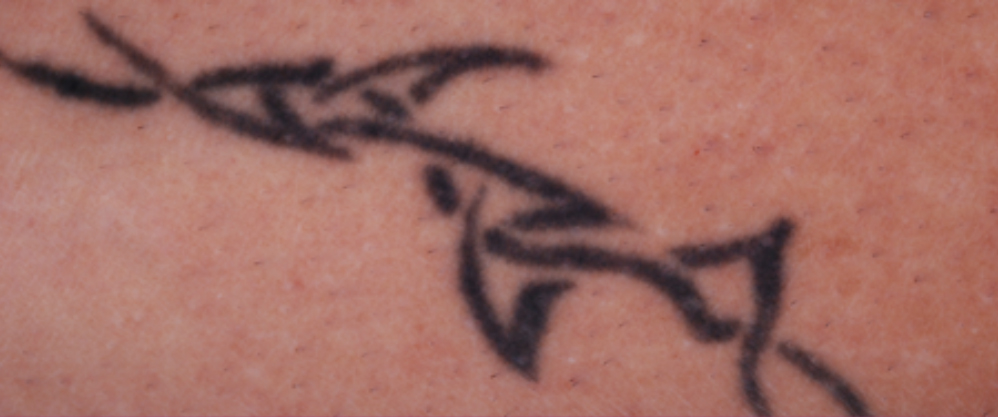 Laser Tattoo Removal Melbourne Australia 99  Clinic Remove Tattoo Near Me